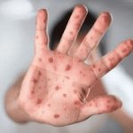 آبله میمونی همه گیر می شود؟ / نشانه‌ها و علائم بیماری چیست؟
