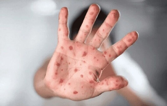 آبله میمونی همه گیر می شود؟ / نشانه‌ها و علائم بیماری چیست؟